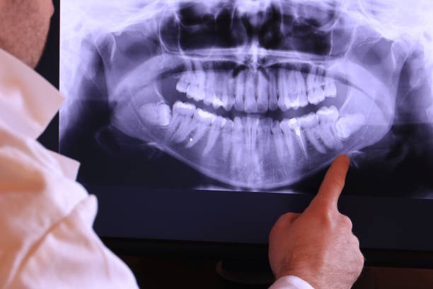 Best Emergency Wisdom Teeth Removal in Trotwood, OH