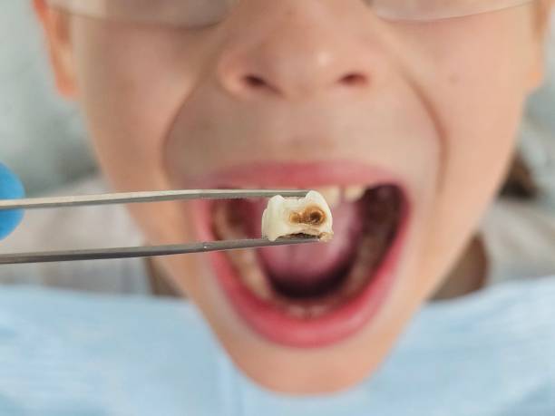 Best Emergency Tooth Extraction in Trotwood, OH