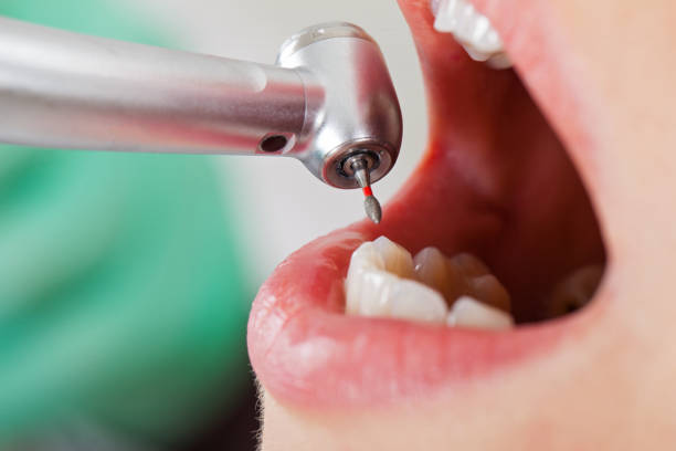 Best Emergency Root Canal Treatment in Trotwood, OH